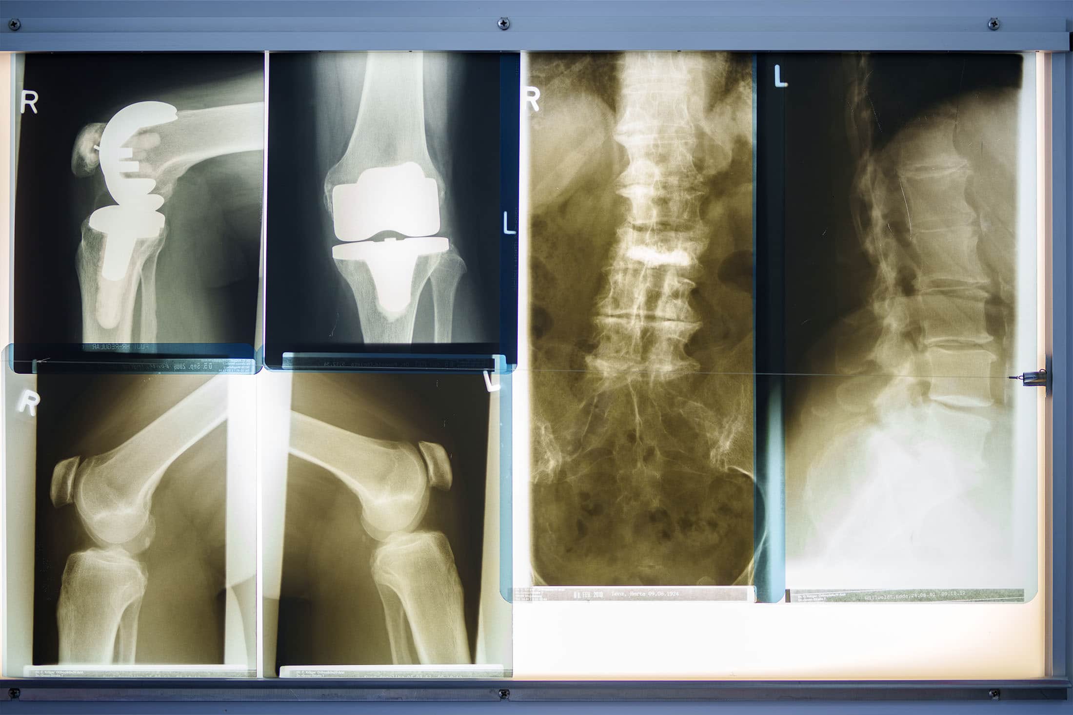 Röntgenbilder von Knie- und Hüftprothesen sowie der Wirbelsäule auf einem Leuchtkasten